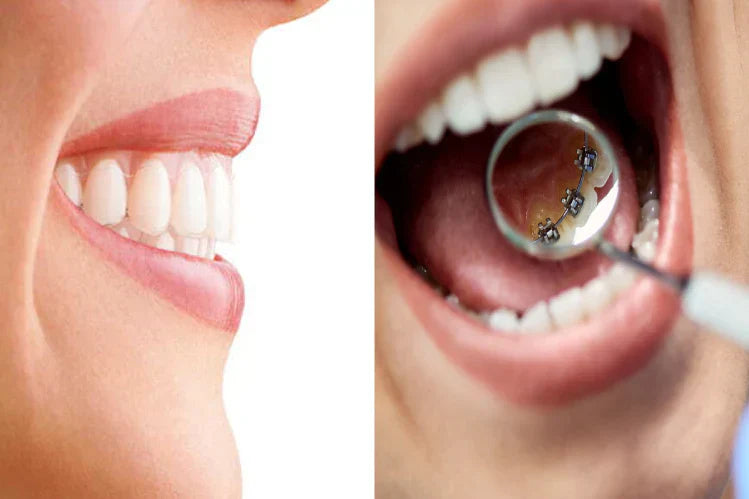 An illustration shows the difference between invisible and lingual braces