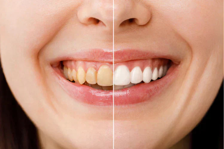Tetracycline teeth before and after the whitening treatment