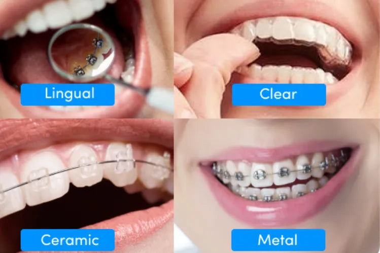  Different treatment options to get straight teeth.
