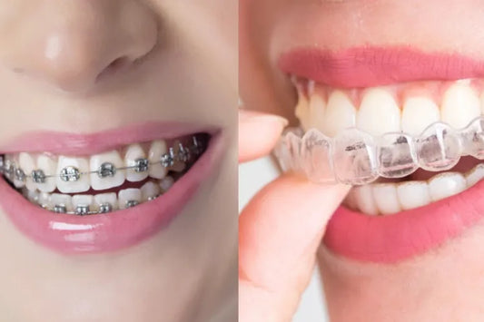 Side-by-side view of a mouth wearing metal braces and another wearing clear aligners.