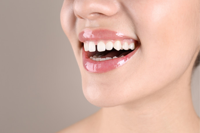 Orthodontic Treatment for Gaps Between Teeth: Closing Spaces for a Beautiful Smile