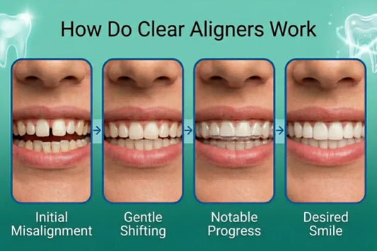  An infographic showing a four-step progression of teeth shifting with clear aligners.
