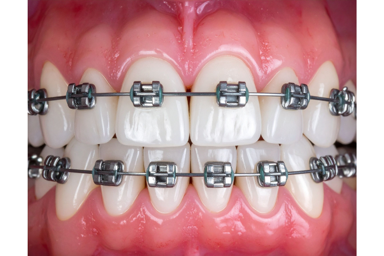 An image of a girl smiling with braces and money bags on the other side