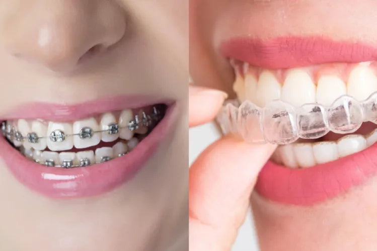 Side-by-side comparison of traditional metal braces with transparent plastic clear aligners.