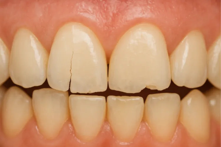 An image shows brittle teeth