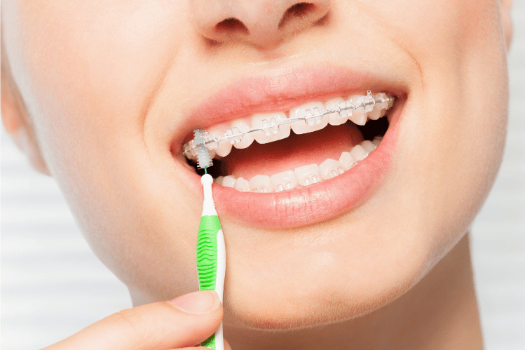 Is Braces Cleaner Similar to an Aligner Cleaner?