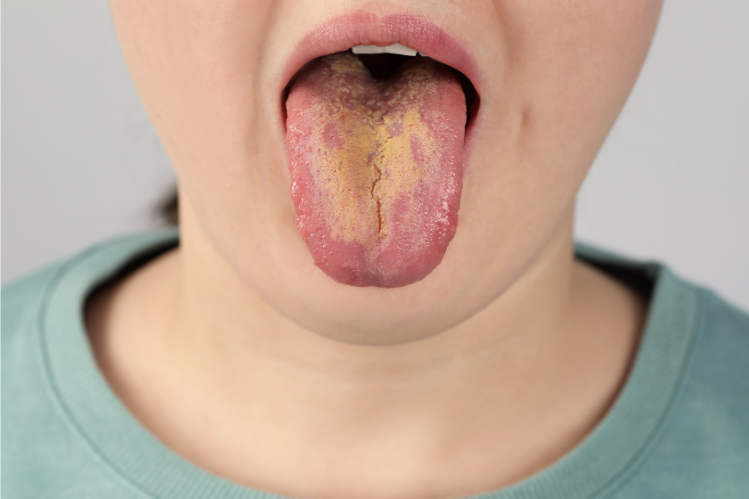 A woman showing her yellowed tongue.