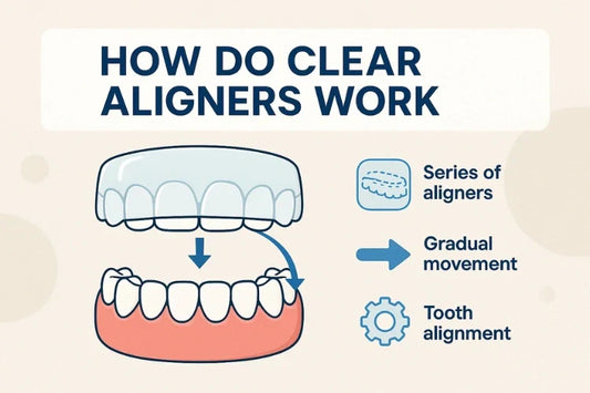 An illustration explaining how do clear aligners work.