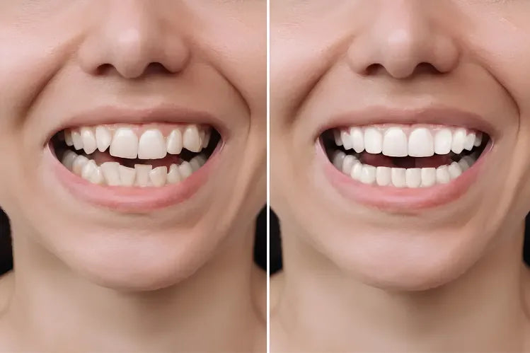 Before-and-after comparison showing crowded, misaligned teeth transformed into a straight smile.