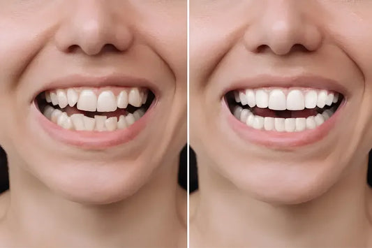 Before-and-after comparison showing crowded, misaligned teeth transformed into a straight smile.