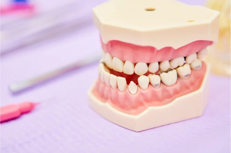 a teeth model with class 1 malocclusion