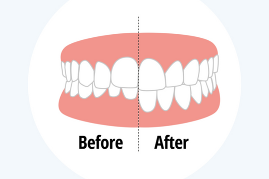 Fix an overbite