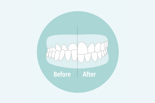 Fix an underbite with clear aligners