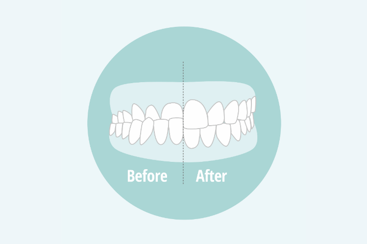 Fix an underbite with clear aligners