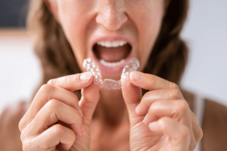 Clear Aligners and Improved Speech Clarity