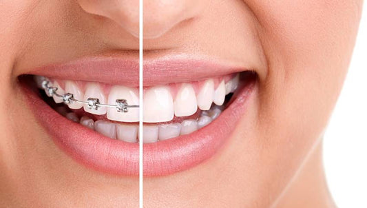 Get Straighten Teeth With Clear Braces