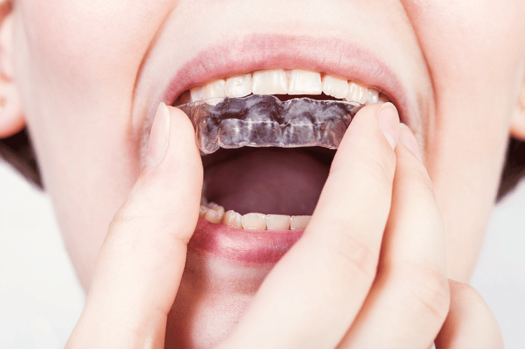 invisible Aligners