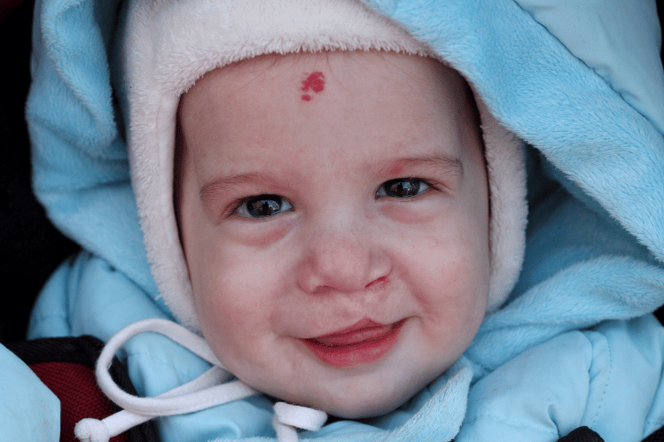 Teeth Straightening for Individuals with Cleft Lip and Palate