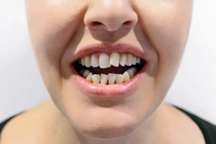 Alternative Orthodontic Solutions for Crooked Front Teeth