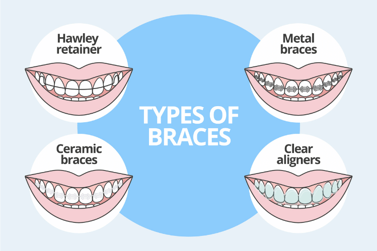 Types of Dental braces