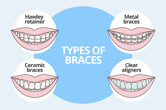 Types of Dental braces