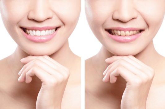 Teeth Whitening Tips for Tea and Herbal Infusion Drinkers