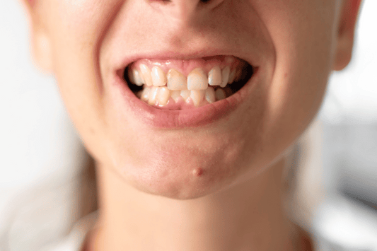 Can clear aligners fix crowded teeth