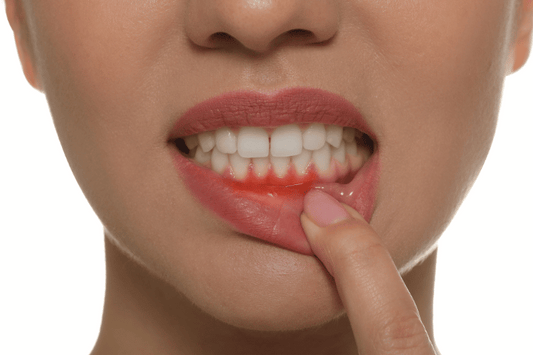 Take care of your gums during clear aligner treatment